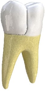 Smiles on Wells provides affordable and painless emergency dental treatments near Pflugerville, TX. Fractured Cusp in Pflugerville, TX