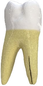 Smiles on Wells provides affordable and painless emergency dental treatments near Pflugerville, TX. Vertical Root Fracture in Pflugerville, TX