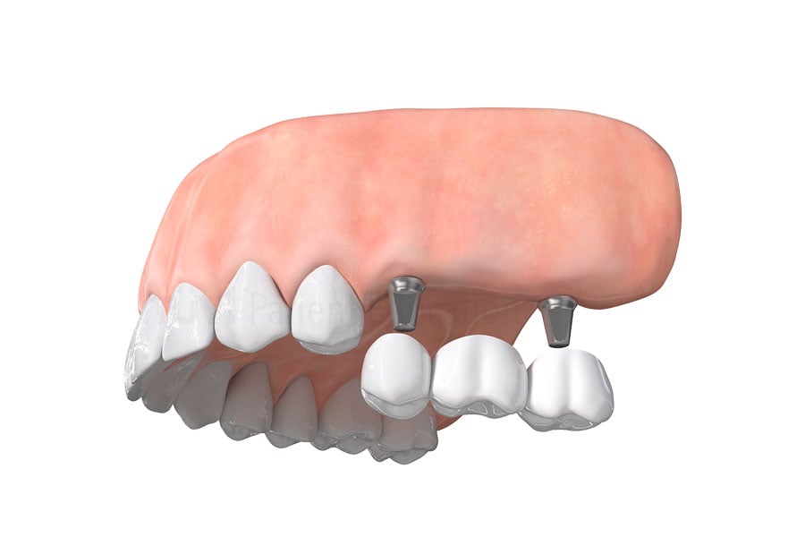 Dental Implant Bridge in Pflugerville, TX