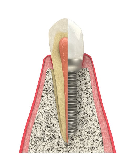 Benefits of Dental Implants in Pflugerville, TX