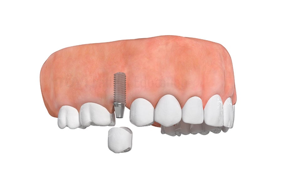 Dental Implants in Pflugerville, TX