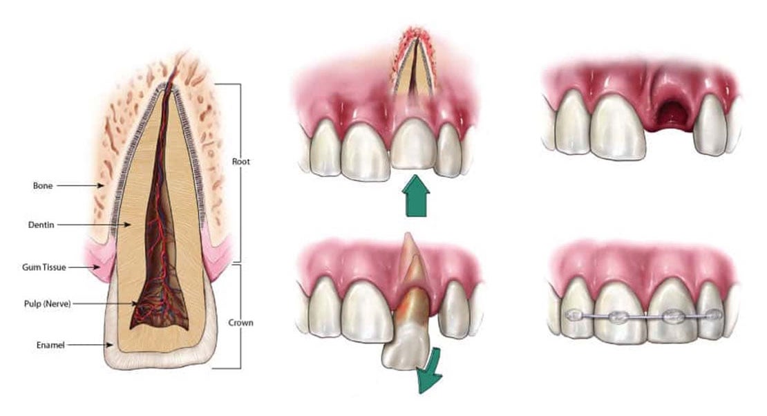 Dr. Michele de Souza, well-qualified emergency dentist in 78660, will help you save your natural tooth from traumatic injuries near Pflugerville, TX. Traumatic Injuries in Pflugerville, TX